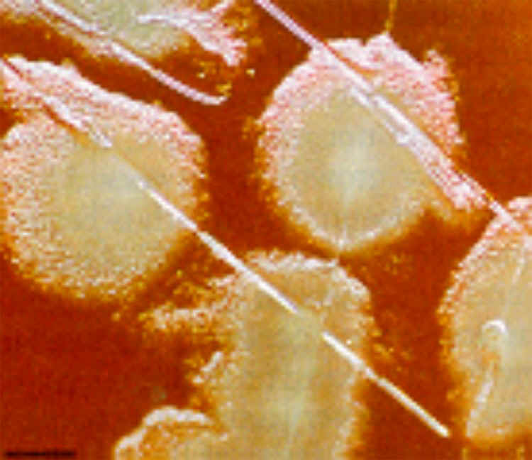 mrsa